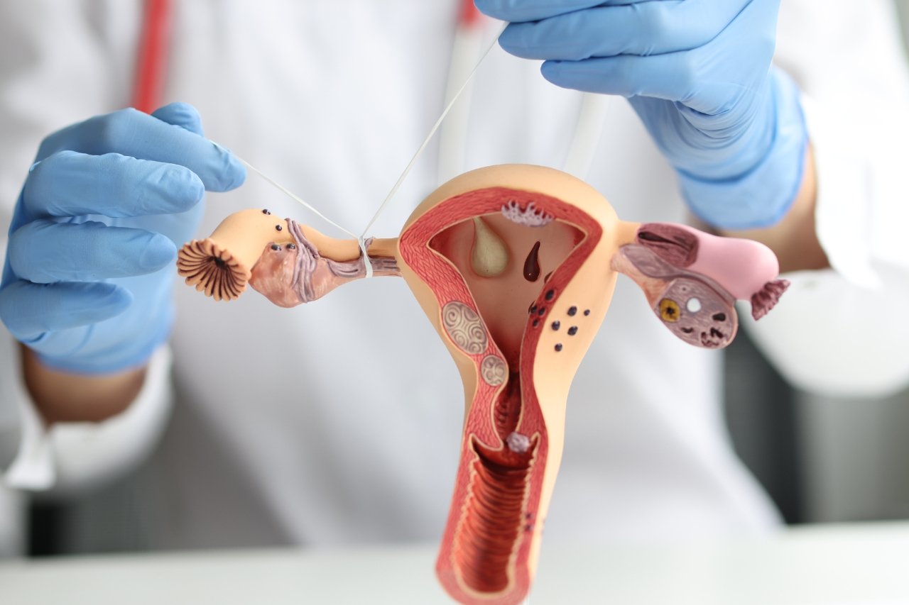 Fallopian tube blockage treatment in Delhi by Dr. Sandeep Talwar